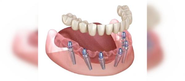 Įdomūs ir mažiau girdėti faktai apie keraminius dantų implantus