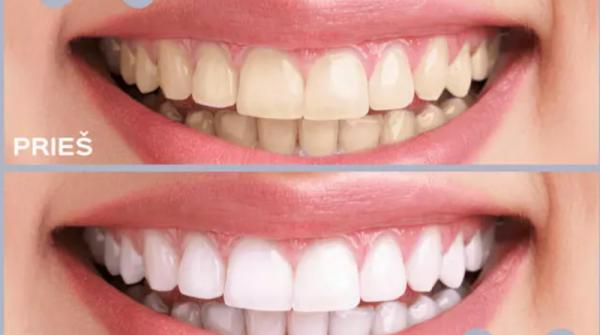 Išvardijo produktus, dėl kurių dantys praranda baltumą: patarė, kaip juos išbalinti patiems