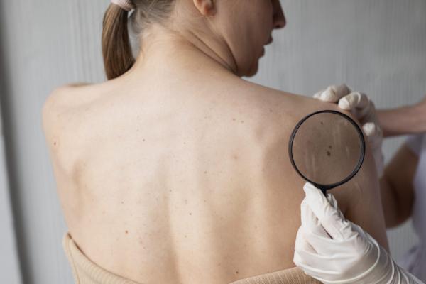 Sveikatos specialistai papasakojo apie tyrimą, galintį padėti nustatyti riziką susirgti melanoma